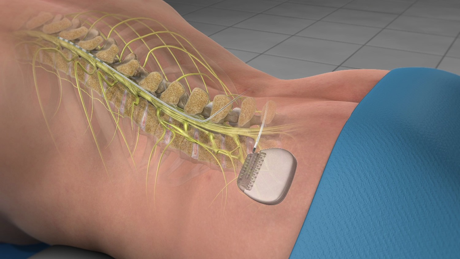 spinal cord stimulation. solution to chronic pain